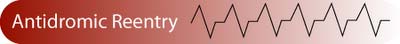 Antidromic Reentry